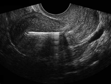 Ultrasonography of intrauterine devices 